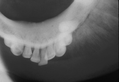 <p>occurs in ~25% of osteosarcoma due to bony projections on the surface of the lesion </p>