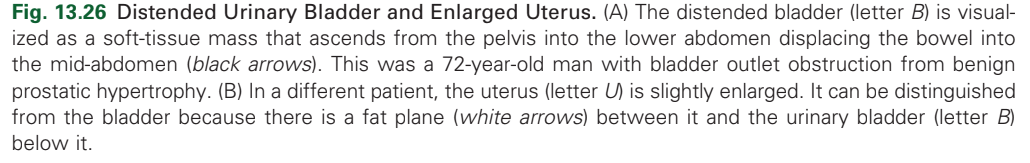 <p>Enlarged Uterus.</p>