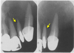 <p>describe the effect of the lesion:</p>
