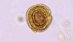 <p>Dark yellow/brown, spheres with concentric circles</p><p>Abnormal, seen with liver disease</p>