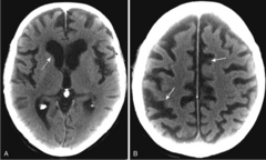 <p>proportionate enlargement of both the ventricles and the sulci</p>