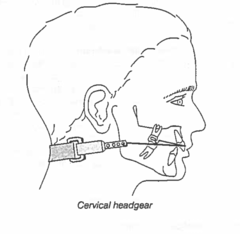 <p>what orthodontic appliance:</p><p>◦ Extraoral removable appliance</p><p>◦ Inserts into bands on the U6s</p><p>◦ Applies pressure to the maxilla restricting forward growth</p><p>◦ This allows the mandible to "catch up"</p><p>◦ Extrudes and distalizes U6s</p><p>◦ Good for deep bites</p>