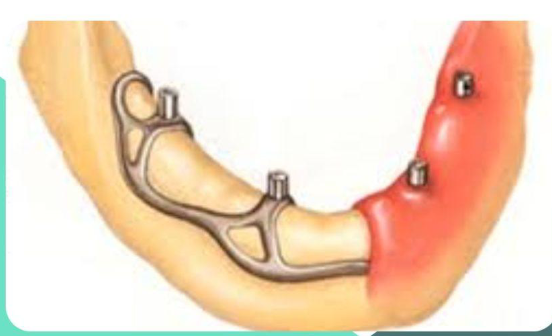 <p>implant that sits below the periosteum </p>