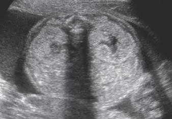 <p>hyperechoic enlarged kidneys </p><ul><li><p>bilateral disease</p></li><li><p>severe oligohydraminos, no bladder</p></li><li><p>lethal, recessive</p></li></ul><p></p>