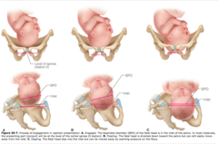 <p>- position of baby's head in relation to the ischial spines (in cm)</p><p>- from -5 to +5; 0 being at the spines</p>