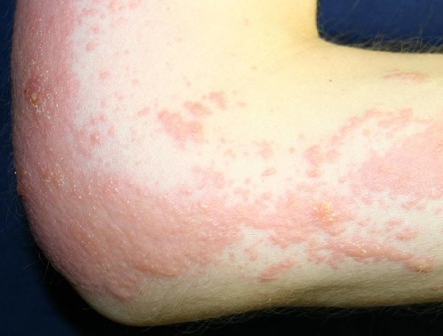 <p>exposure to allergen like poison ivy</p><p>-linear lesions</p>
