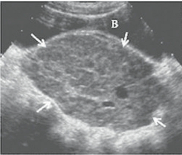 <p>This is an example of a ____ ____ tumor </p>