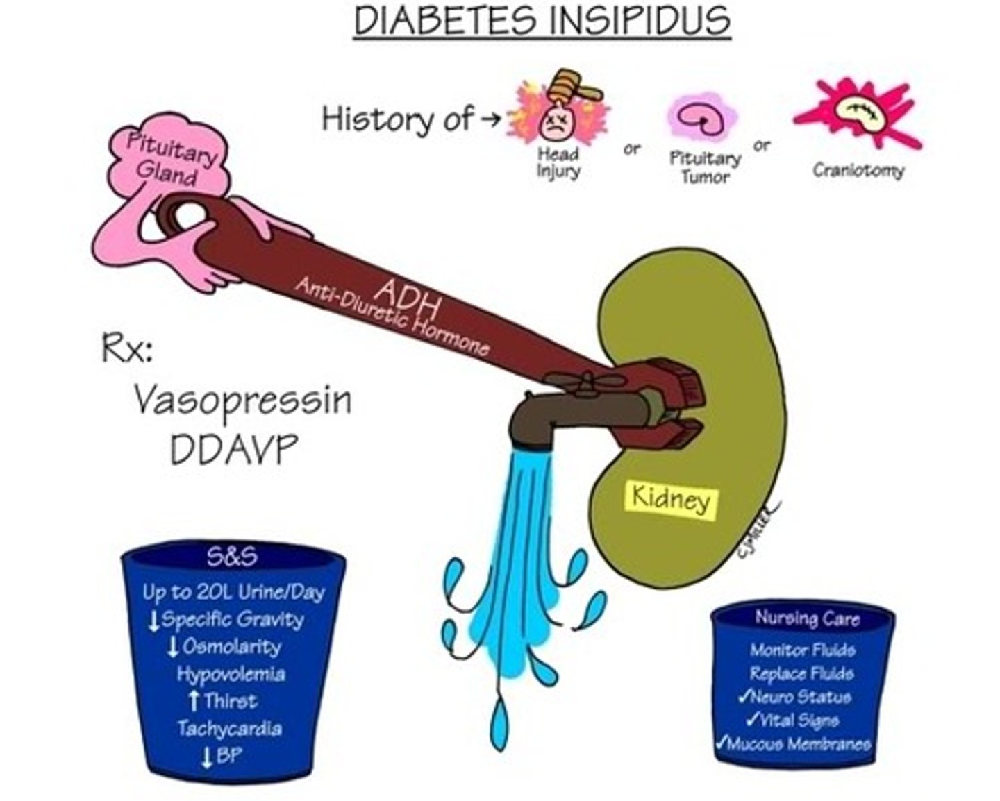 <p>-rare</p><p>-causes by trauma, tumor on pituitary, craniotomy</p><p>-Sx: polyuria (frequent urination) and polydipsia (increases thirst)</p><p>-not enough ADH so dumping tons of water into urine, so pt. is severely dehydrated. All of the water is exiting through the kidneys and now have an inability to concentrate urine (ability to pick and choose what we want in the nephron)</p><p>-increased plasma osmolality: blood vessel with not enough water and tons of solutes, hyperosmolar state, blood is thick and viscous, syrupy due to lots of solutes</p><p>-hypernatremia not related with intake of salt, all a water problem</p><p>-Sx: increased thirst due to losing a lot, urinating at night, can lose up to 20 L of urine in a day (hypovolemic), tachycardic: super dehydrated so heart has to work harder and there isnt a lot of volume</p><p>tx: vasopressin (artificial ADH)</p>