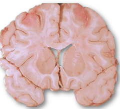<p>What is a watershed infarct?</p>
