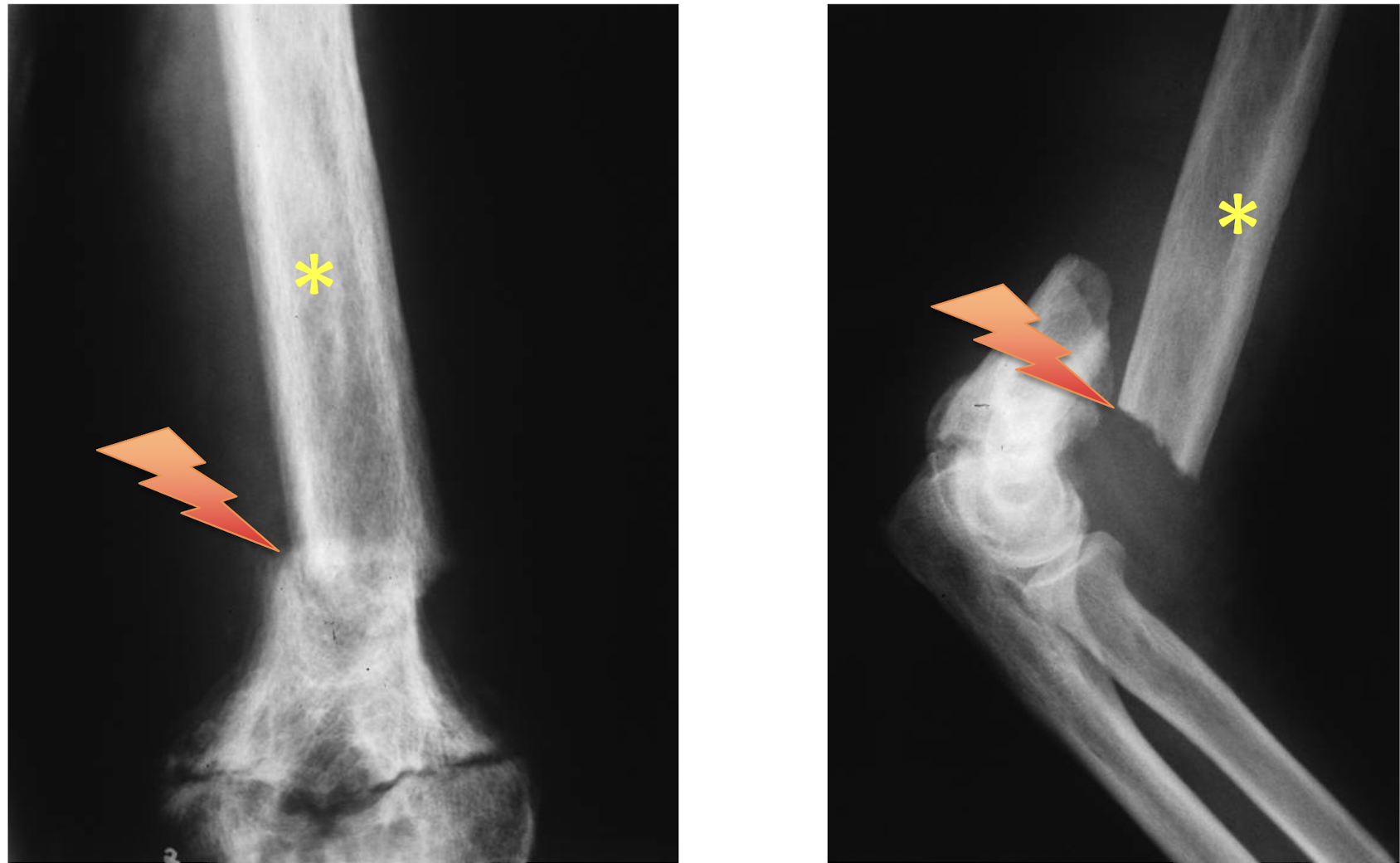 <p>What tumour like disorder is this? </p>