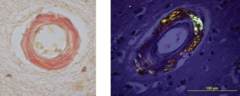 <p>What stain highlights amyloid in CAA?</p>