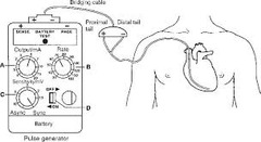 <p>cardiac pacemaker using a pacing electrode or wire passed through a vein into the chambers of the heart that stimulates and maintains a normal heart rate; may be permanent or temporary</p>