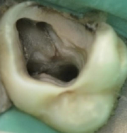 <p>What does the mesiobuccal root look like?</p>