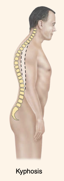 <p>What is kyphosis?</p>