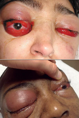 <p>one of the most severe complications of a maxillary odontogenic infection</p><p>a rare, life-threatening condition where a blood clot (thrombus) forms in the cavernous sinus</p><ul><li><p>usually a<strong> late complication of:</strong></p><ul><li><p><span style="color: red;">infection of the central face</span></p></li><li><p><span style="color: red;">paranasal sinus infections</span></p></li></ul></li><li><p><strong>other causes:</strong></p><ul><li><p><span style="color: red;">extraction of mx anterior teeth</span> in the presence of an <span style="color: red;">acute infection</span></p></li></ul></li><li><p>tx:</p><ul><li><p>mainstay is <span style="color: red;">aggressive antibiotic administration</span></p></li></ul></li></ul><p></p>