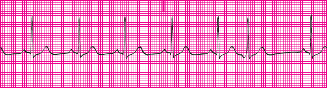 <p>Which rhythm is this?</p>