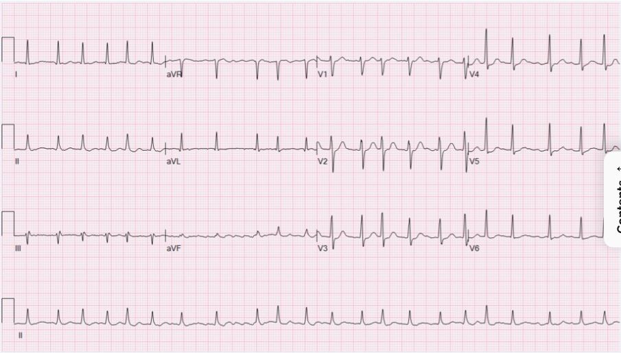 <ol><li><p>Rate = Tachycardic</p></li><li><p>Rhythm = irregularly irregular</p></li><li><p>Axis = Typically normal, although there usually is no clear isoelectric baseline</p></li><li><p>Wave components:</p></li></ol><ul><li><p></p><ul><li><p>P waves - absent. Instead there are chaotic fibrillatory waves.</p></li><li><p>QRS complexes - narrow (normal), variable R-R intervals.</p></li></ul></li></ul><ol><li><p>Summary: The ECG shows atrial fibrillation with a rapid ventricular response rate of about 132 bpm with a normal axis and QRS duration. R-R intervals are variable, showing an irregularly irregular rhythm. There is normal R progression, but no evidence of discrete P waves either normal or ectopic excluding sinus / atrial tachycardia.</p></li></ol><p></p>