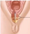 <p>Perineal laceration involving muscles but not the anal sphincter</p>