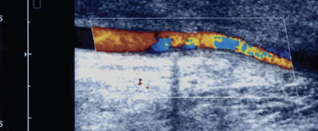 <ul><li><p>indicates mild changes in flow profiles</p></li><li><p>aliasing in stenosis</p></li></ul><p></p>