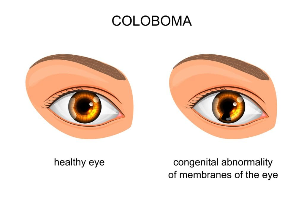 <p>A defect in the eye's structure resulting in a gap or missing tissue, commonly affecting the iris but can also involve the retina and optic nerve. </p>
