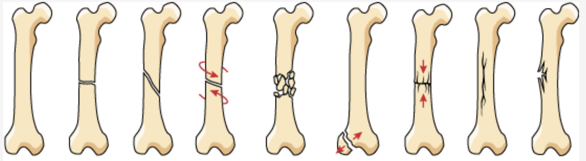 <p>what is the fourth fracture called?</p>
