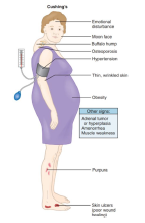 <ul><li><p>Moon facies and<strong> buffalo hump fat deposits</strong></p></li></ul><p>•Truncal obesity with limb muscle wasting (skinny limbs)</p><p>•Skin fragility with <strong>bruising and striae</strong></p><p>•Hyperglycemia and mood disturbances common</p><p>•<strong>Oral infections and periodontal risk increased</strong></p><ul><li><p>(extra cushion)</p></li></ul><p></p>