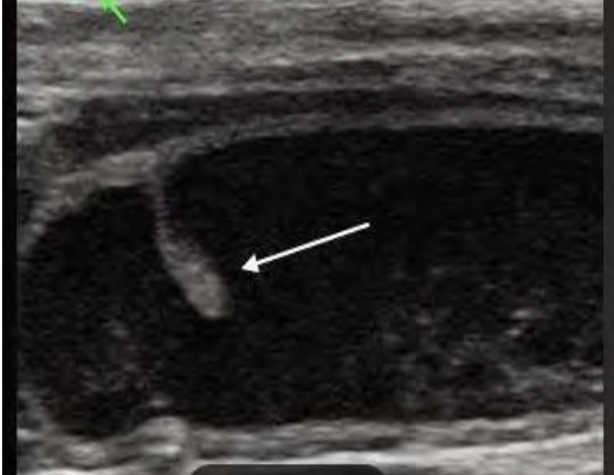 <p>what does the following ultrasound show?</p>