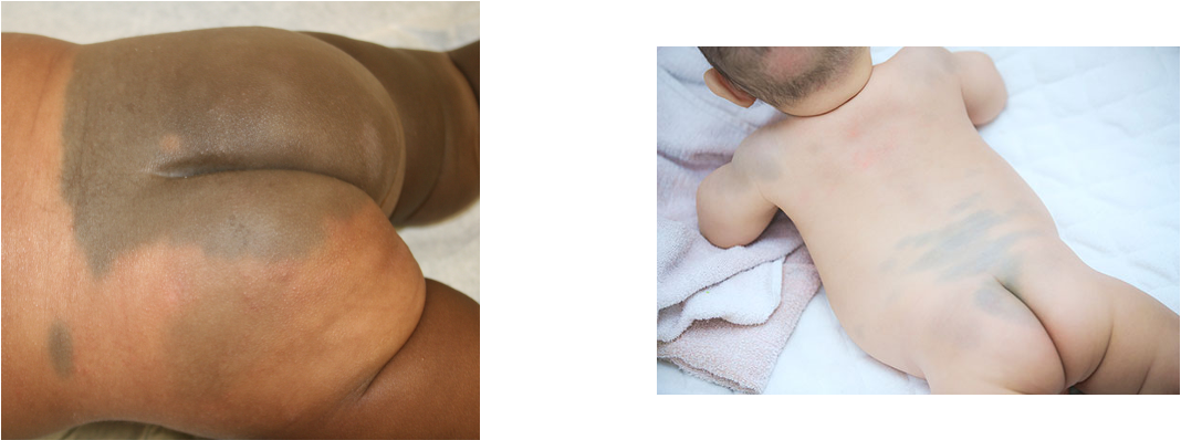 <p>the sacrum, but can be anywhere </p>