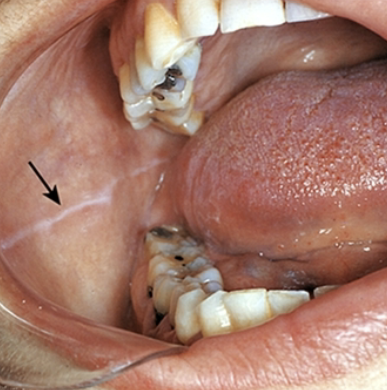 <p>may be bilateral, can be more prominent in patients who have a clenching/ bruxing habit </p>