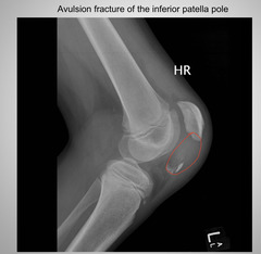 <p>Avulsion fracture</p>
