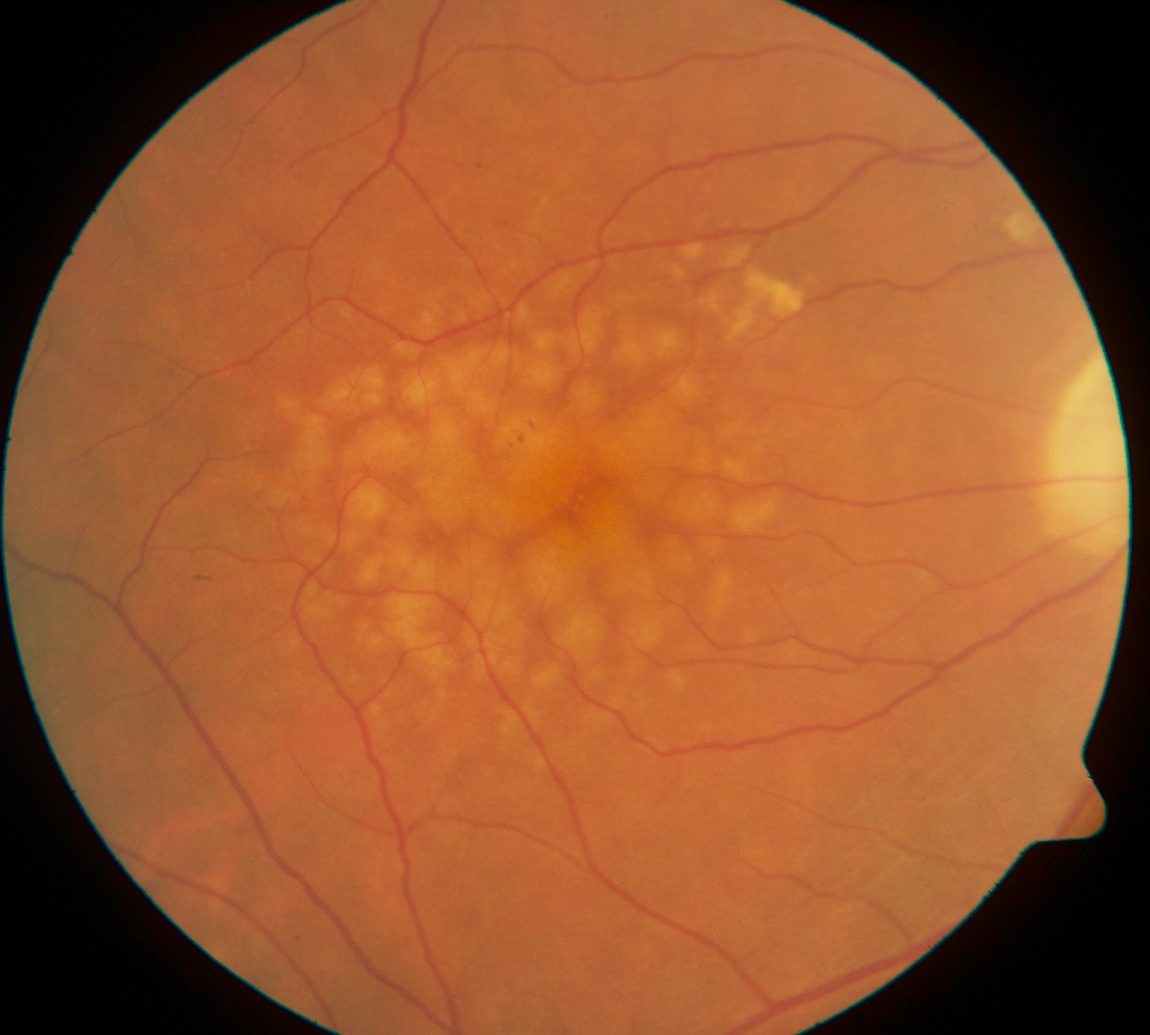 <p>benign deposits on the ocular fundus that show as round yellow dots and occur with aging </p>