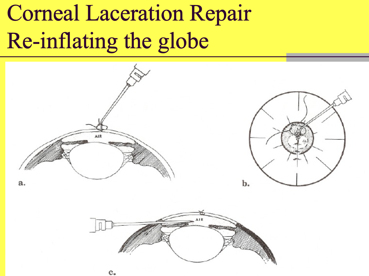 <p>placing air in the anterior chamber - can be through incision w/ canula or in another location (difficult in a flat eye).</p>