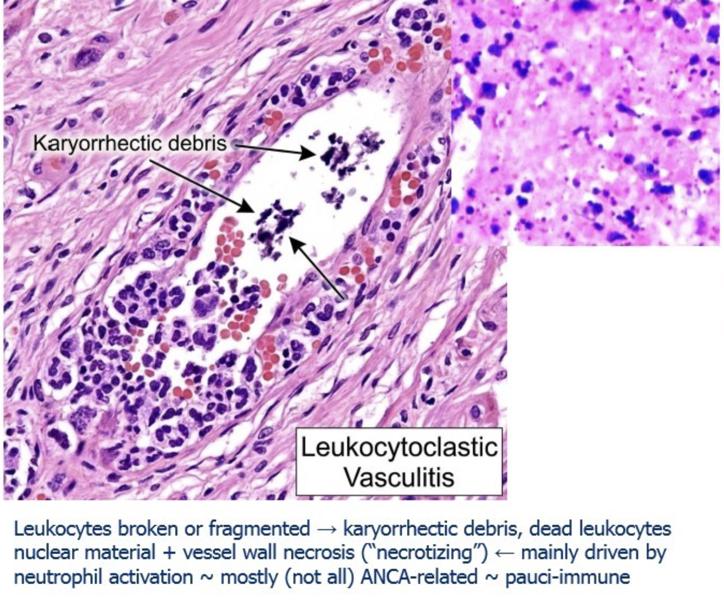 <p>basically means inflammation driven by neutrophils (“leuko”) that break apart (“clastic”). In this condition, neutrophils become highly activated—often due to antibodies like Antineutrophil cytoplasmic antibodies—and release toxic enzymes that damage vessel walls. As these neutrophils die, their nuclei fragment into tiny pieces called karyorrhectic debris, which appear as small dark dots under the microscope. So the name reflects the key feature: blood vessel damage with broken-down neutrophil debris deposited in the tissue.</p>