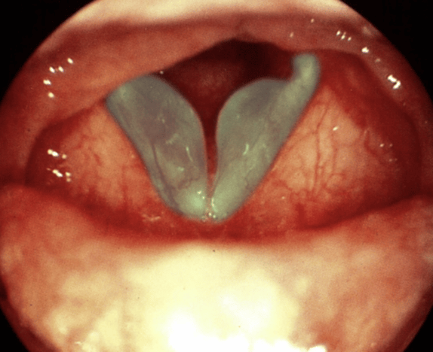 <p>E) vocal chords</p><p>EXPLANATION</p><p>Reinke oedema is located at the vocal cords, and is prominent in heavy smokers.</p>