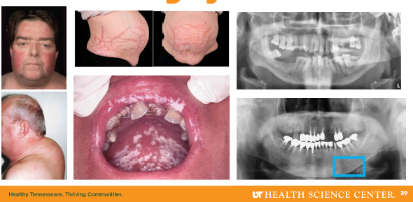 <ul><li><p>Diagnosis via cortisol testing and exam</p></li></ul><p>•Surgical removal for endogenous causes</p><p>•Medication cases require careful adjustment</p><p>•Monitor infection risk and healing capacity</p><p>•Stress dose steroids may be required</p>