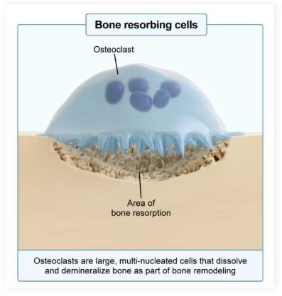 <p><strong>Bone Degrading cells</strong></p><p></p><p><strong>Eat </strong>and <strong>resorb </strong>bone by <strong>releasing enzymes </strong>and <strong>reducing pH </strong>(increasing acidity)</p><ul><li><p>Release <strong>calcium </strong>and <strong>phosphate </strong>back into the <strong>blood</strong></p></li></ul><p></p>