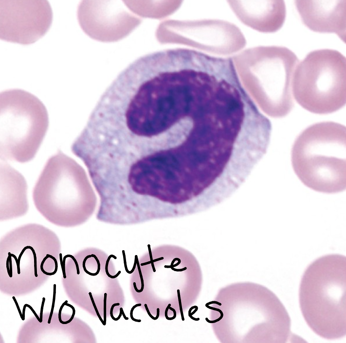 <p>Monocyte</p><p>12-20 micrometers, variable nucleus, may be round, horseshoe shaped, or kidney shaped; often has fold producing “brain-like convolutions”, lacy chromatin, Blue-gray cytoplasm; may have psuedopods, many fine granules frequently giving the appearance of ground glass. May or may not have vacuoles, N:C ratio variable. CD 33, 13, 14</p>