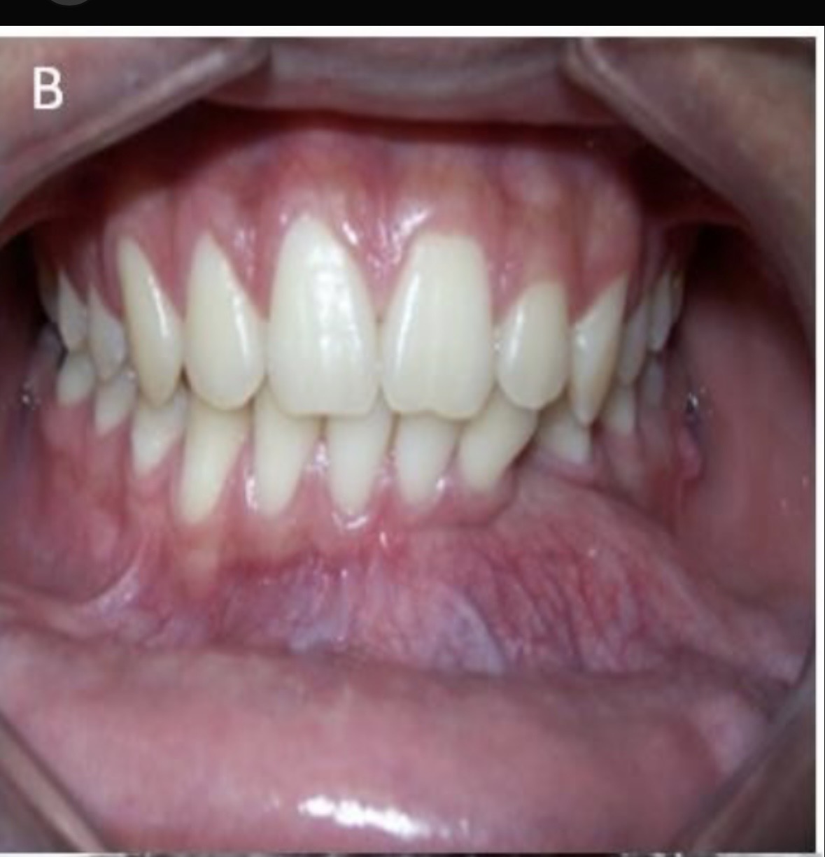 <p><span>Expansión mandibular, asimetría facial y movilidad dental.</span></p>