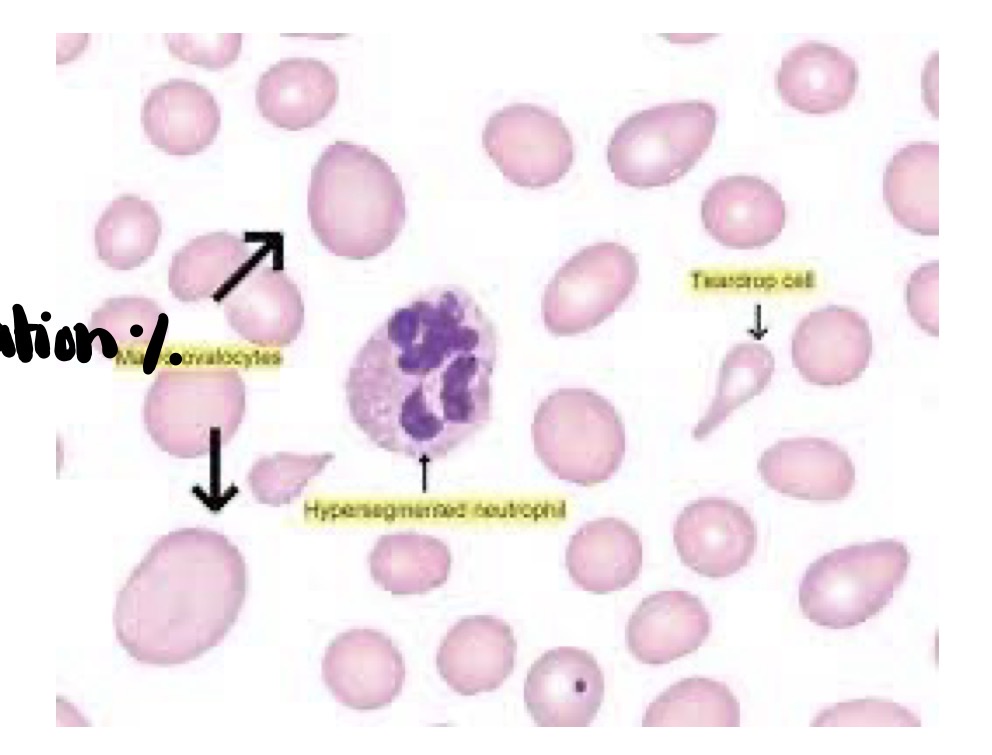 <p>What is Megaloblastic anemia </p>