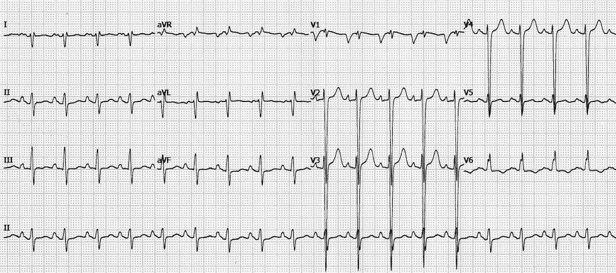 <p>A 54-year-old man with a history of chronic alcohol use presents to the clinic with progressive fatigue, dyspnea on exertion, and bilateral lower extremity swelling for the past 3 months. Vital signs reveal blood pressure of 102/68 mm Hg and heart rate of 108 bpm. Physical examination shows jugular venous distention, bibasilar crackles, and 2+ pitting edema of the legs. Cardiac auscultation reveals an S3 gallop. Echocardiogram demonstrates four-chamber enlargement with reduced ejection fraction. What is the most likely diagnosis?</p>