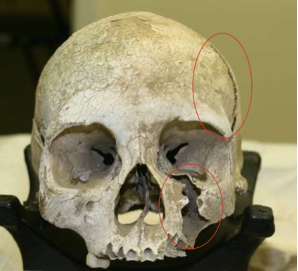 <p>is this injury antemortem, perimortem, or postmortem?</p>