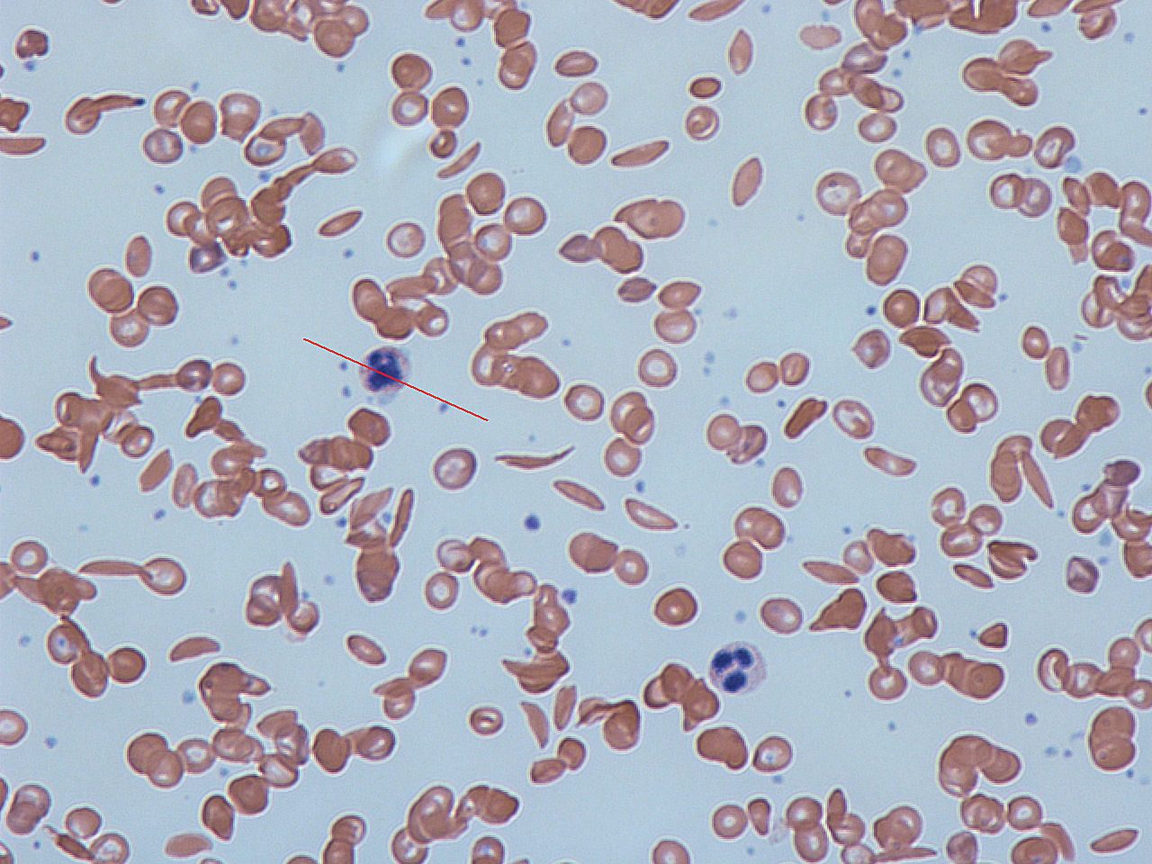 <p>Compared to a normal smear, this sample shows abnormally shaped RBCs:</p>
