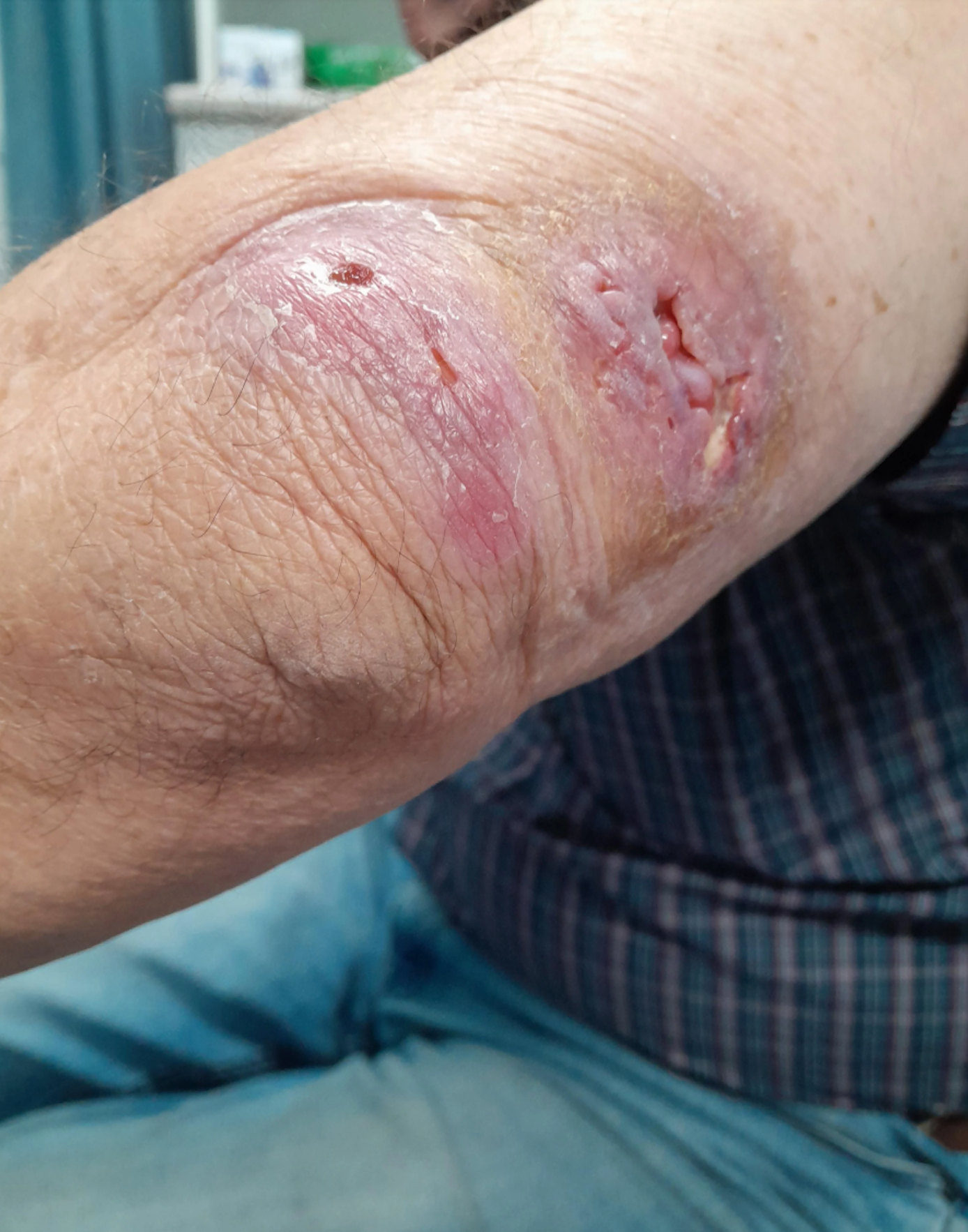 <p>What bandaging technique should be used for this injury?</p>