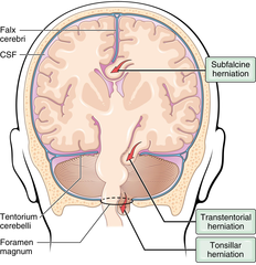 <p>Which cranial nerve is compressed in transtentorial/uncal herniation and what is the sign?</p>
