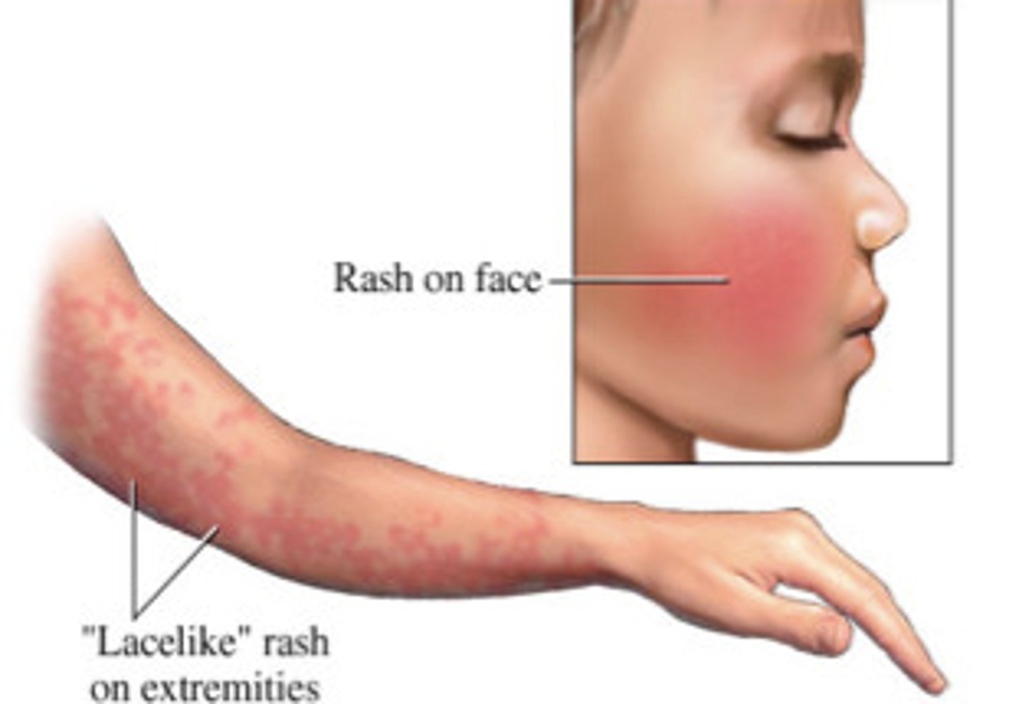 <p>Parvovirus B19</p><p>"slapped cheek" look with a subsequent lacy, maculopapular, evanescent rash on the trunk and limbs</p><p>common in ages 5-15</p>