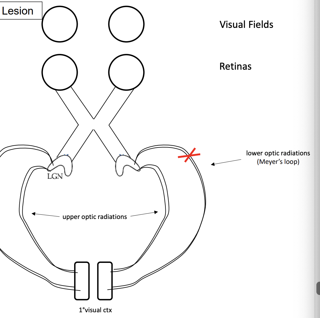 <p>pie shape, can see everything expect top left quarter of visual field</p>