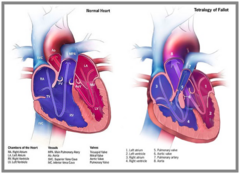 <p>- cyanotic</p><p>- DOE</p><p>- hyercyanotic spells called "tet spells"</p><p>- squatting helps increase systemic resistance → decreasing venous return to the heart → more O2 blood available to the body</p>