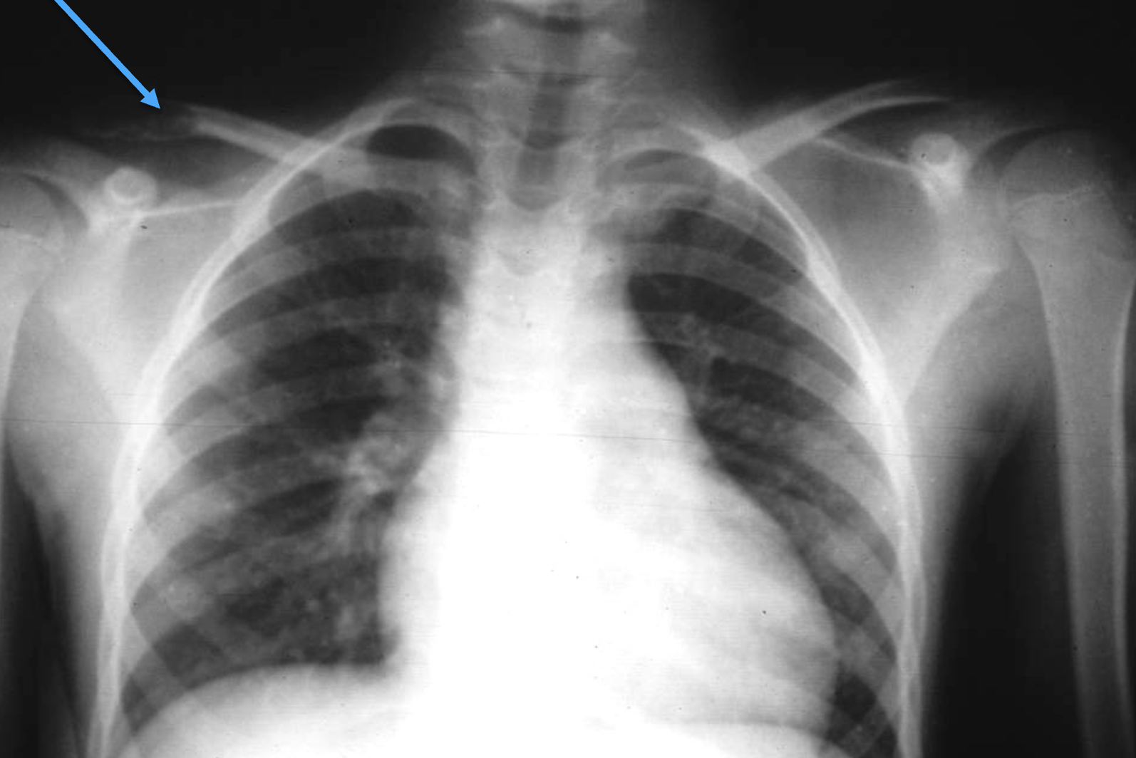 <p>What tumour-like condition is this, what bone is it in and what can be seen?</p><p></p>