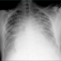 <p>- Fatigue: lungs cant get enough oxygen to lungs </p><p>- Dyspnea: shortness of breath with activity </p><p>- Orthopnea: shortness of breath laying down (they are drowning in their own blood)</p><p>- Paroxysmal Nocturnal Dyspnea</p>