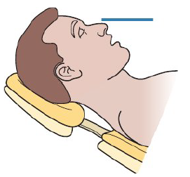 <ul><li><p>Angle headrest forward and down — chin lower than nose level</p></li><li><p>Occlusal and incisal surfaces should be parallel to floor </p></li><li><p>This is<strong> chin down position</strong></p></li></ul><p></p>